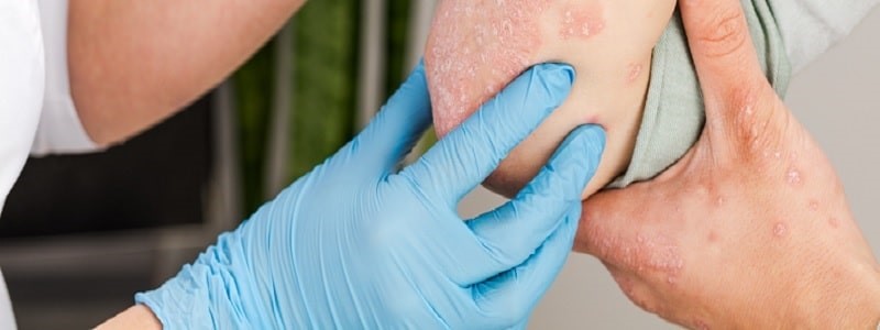 Occupational Health Skin Surveillance